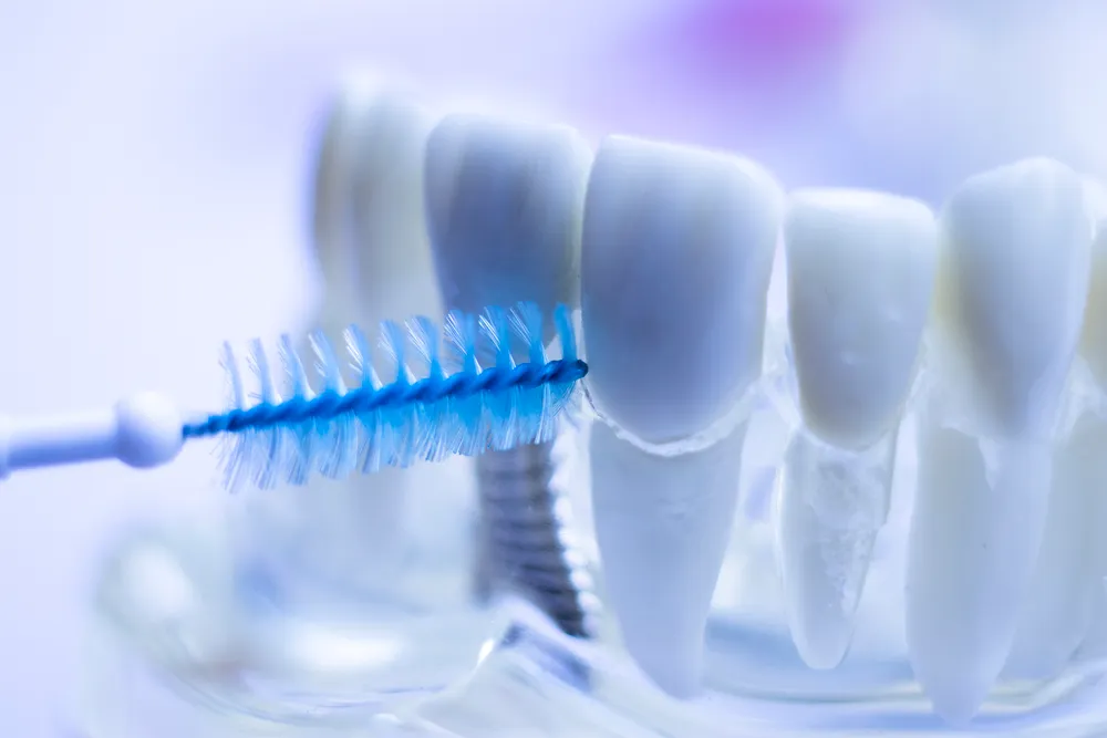Os benefícios das escovas interdentais para dentes